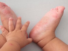 Trẻ bị bệnh tay chân miệng độ 1- Mẹ chăm sóc bé tại nhà ra sao?